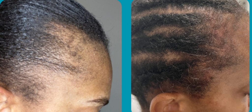 Hair Restoration Before and After Image | Vida Aesthetics And Wellness in Houston, TX