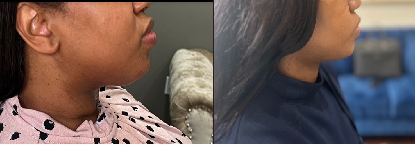 Lipodissolve Before and After Image | Rachel Brown NP in Houston, TX