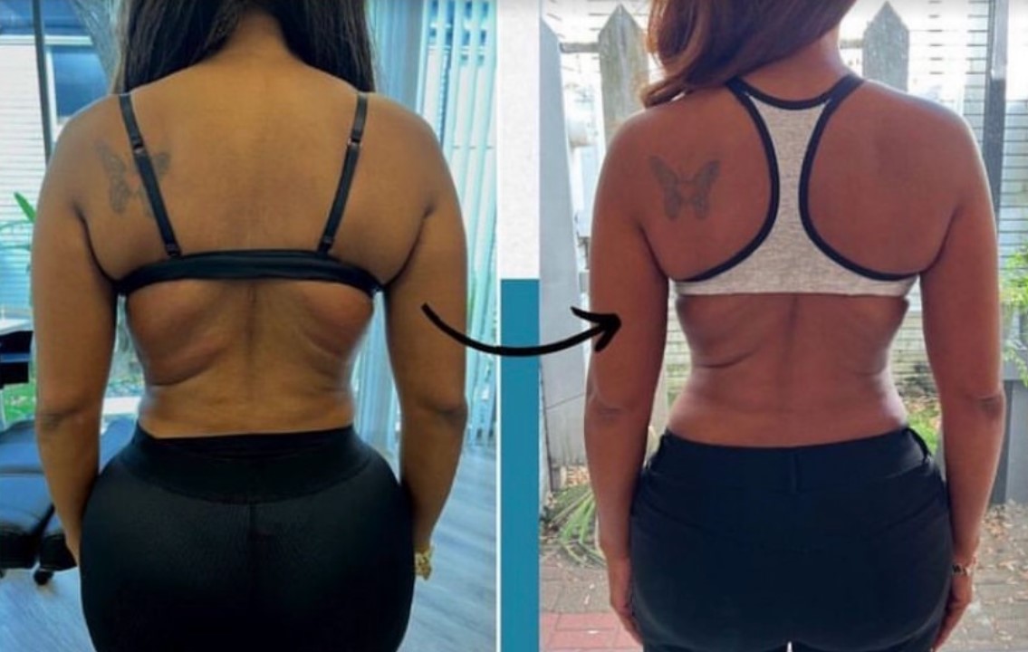 Before and After Lipodissolve treatment | Rachel Brown NP in Houston, TX