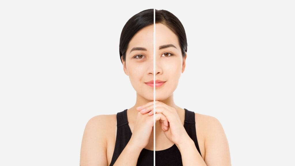Before & After effects of Bioreel Peel Treatment in Houston, TX | Vida Aesthetics And Wellness