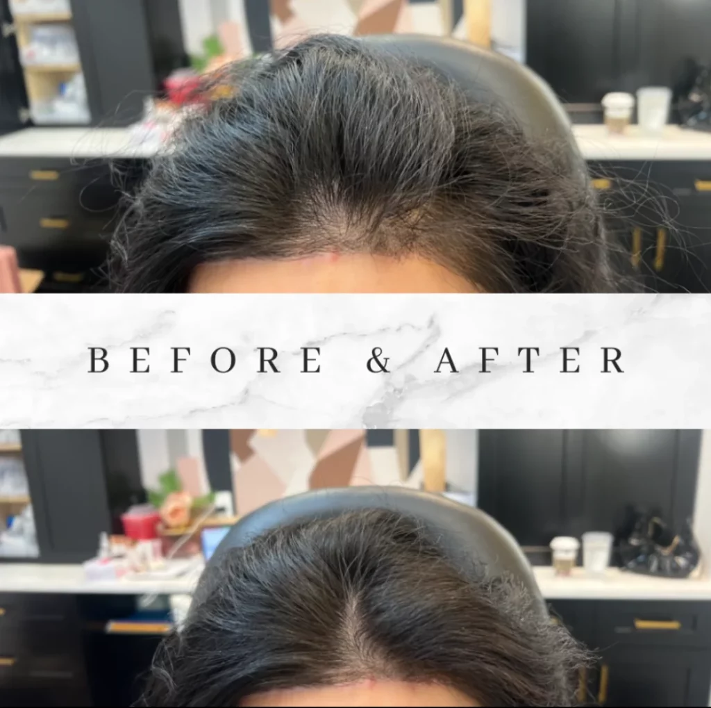 Keravive Scalp Therapy Before and After Photos in Houston, TX | Vida Aesthetics And Wellness