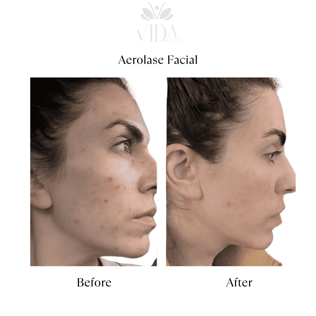 Facial Services-Before-After (2)