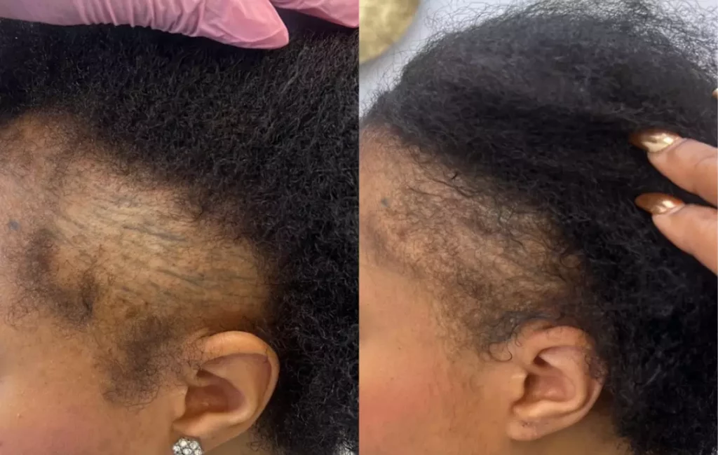 Advance Hair Restoration Treatment Patient Before and After Photos in Houston, TX | Vida Aesthetics And Wellness