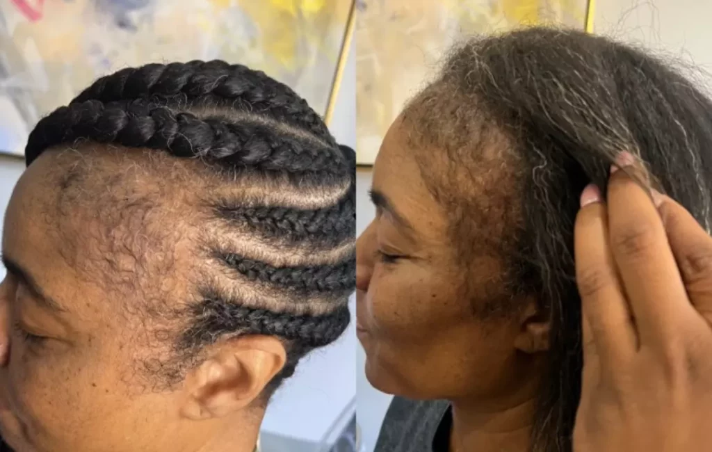 Advance Hair Restoration Treatment Patient Before and After Photos in Houston, TX | Vida Aesthetics And Wellness