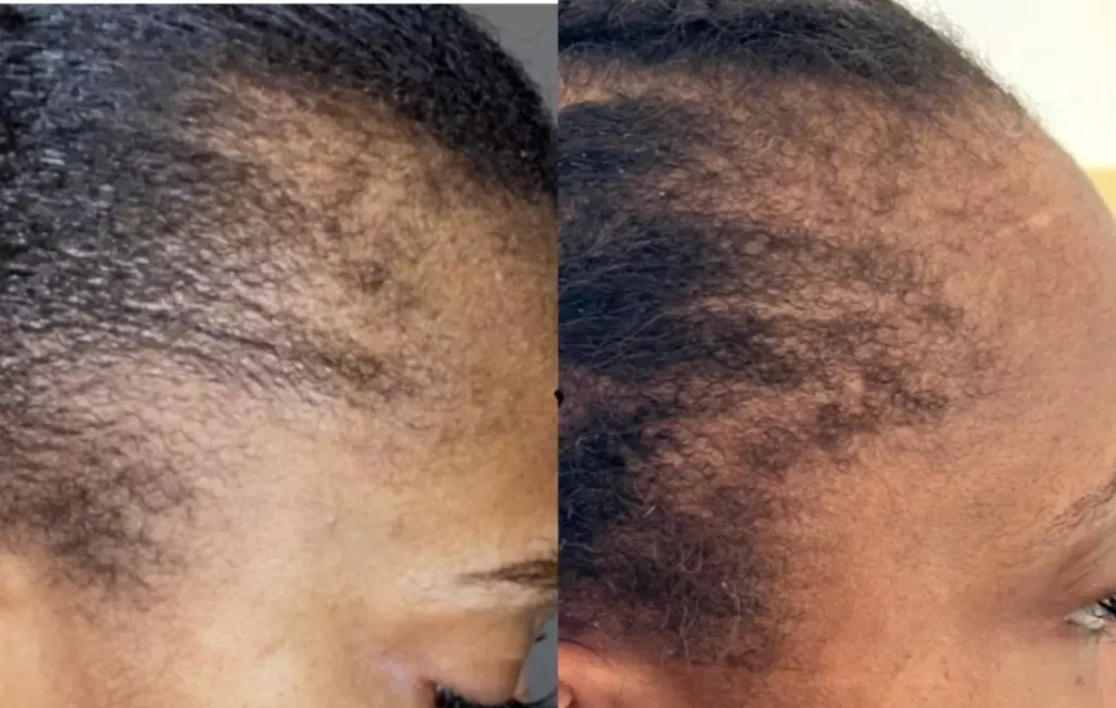 Advance Hair Restoration Treatment Patient Before and After Photos in Houston, TX | Vida Aesthetics And Wellness