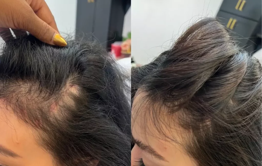 Advance Hair Restoration Treatment Patient Before and After Photos in Houston, TX | Vida Aesthetics And Wellness