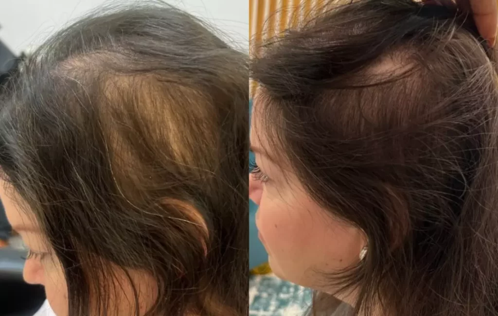 Advance Hair Restoration Treatment Patient Before and After Photos in Houston, TX | Vida Aesthetics And Wellness