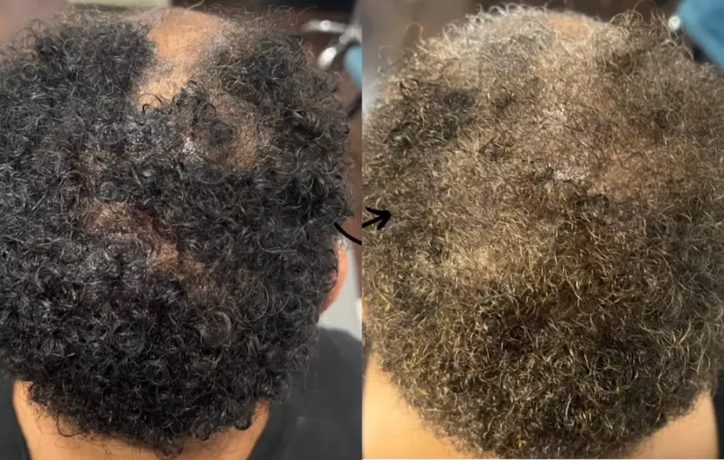 Advance Hair Restoration Treatment Patient Before and After Photos in Houston, TX | Vida Aesthetics And Wellness