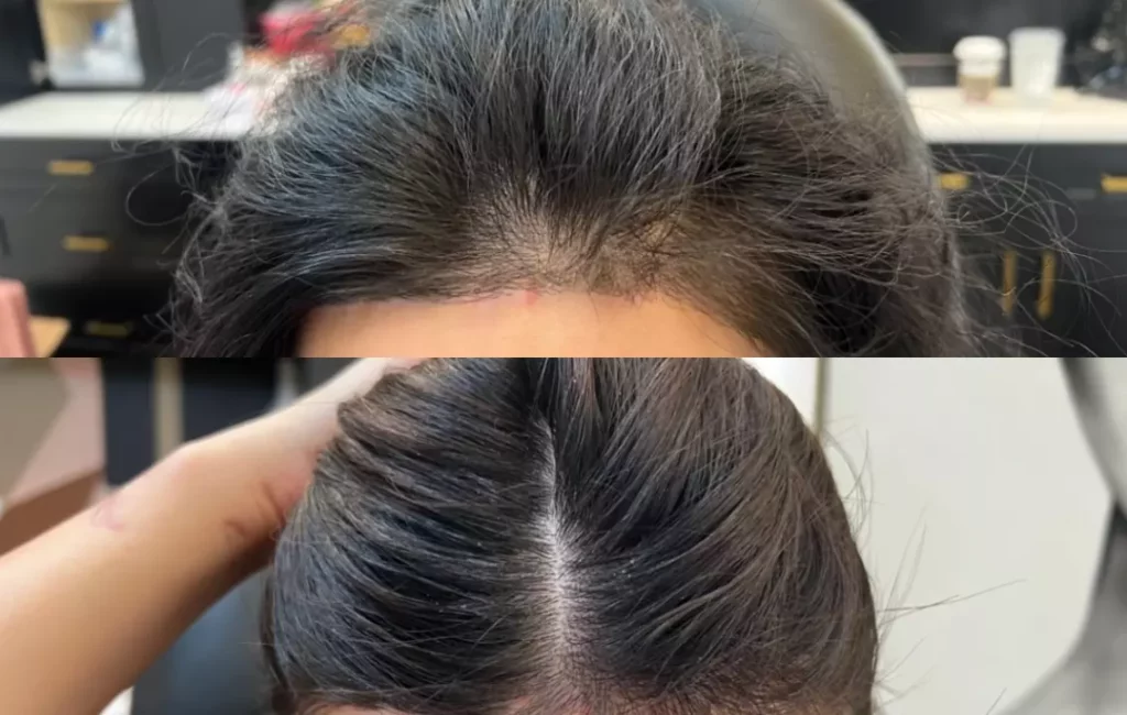 Advance Hair Restoration Treatment Patient Before and After Photos in Houston, TX | Vida Aesthetics And Wellness