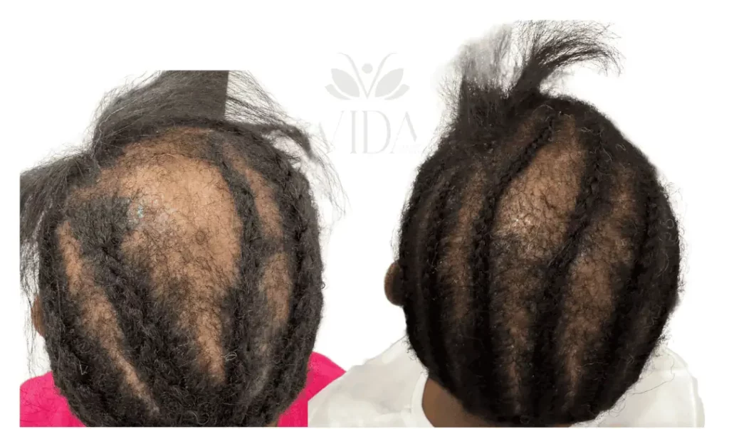 ADVANCE HAIR RESTORATION BEFORE AND AFTER