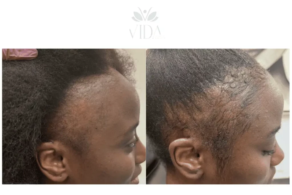 ADVANCE HAIR RESTORATION BEFORE AND AFTER (2)