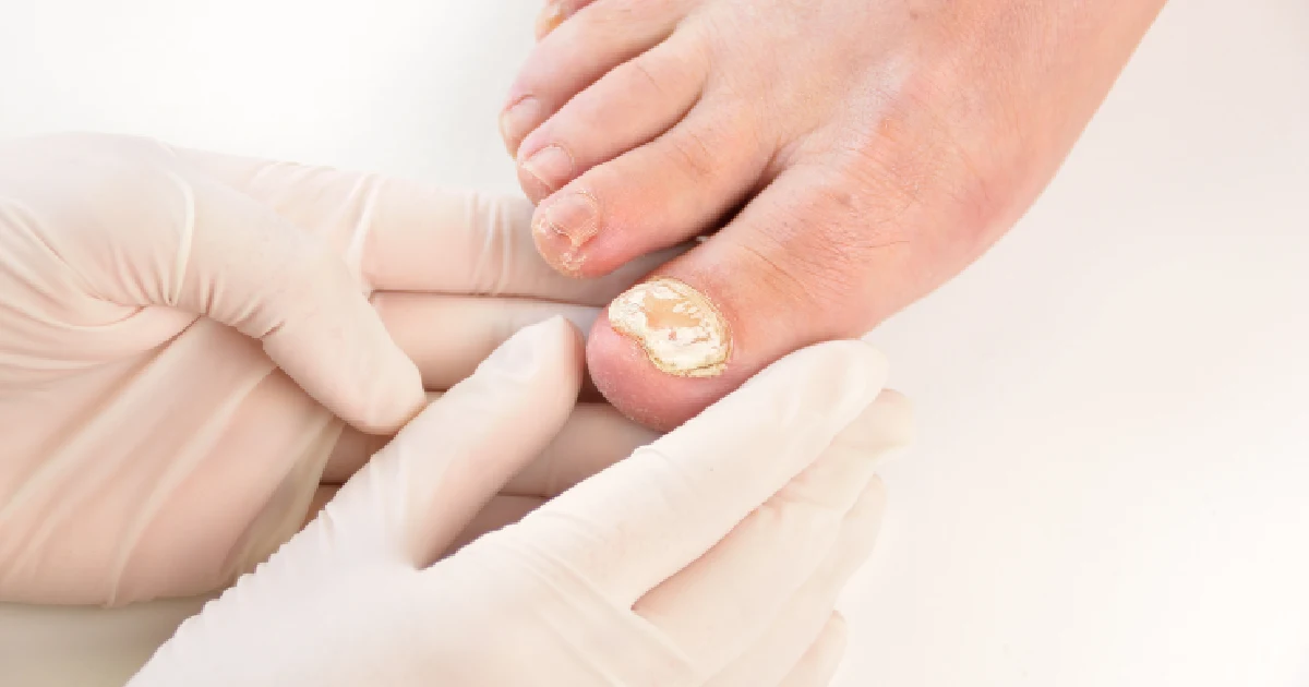 toenail infected with fungus, preparing for treatment with Aerolase Neo Elite laser therapy in Houston, tx