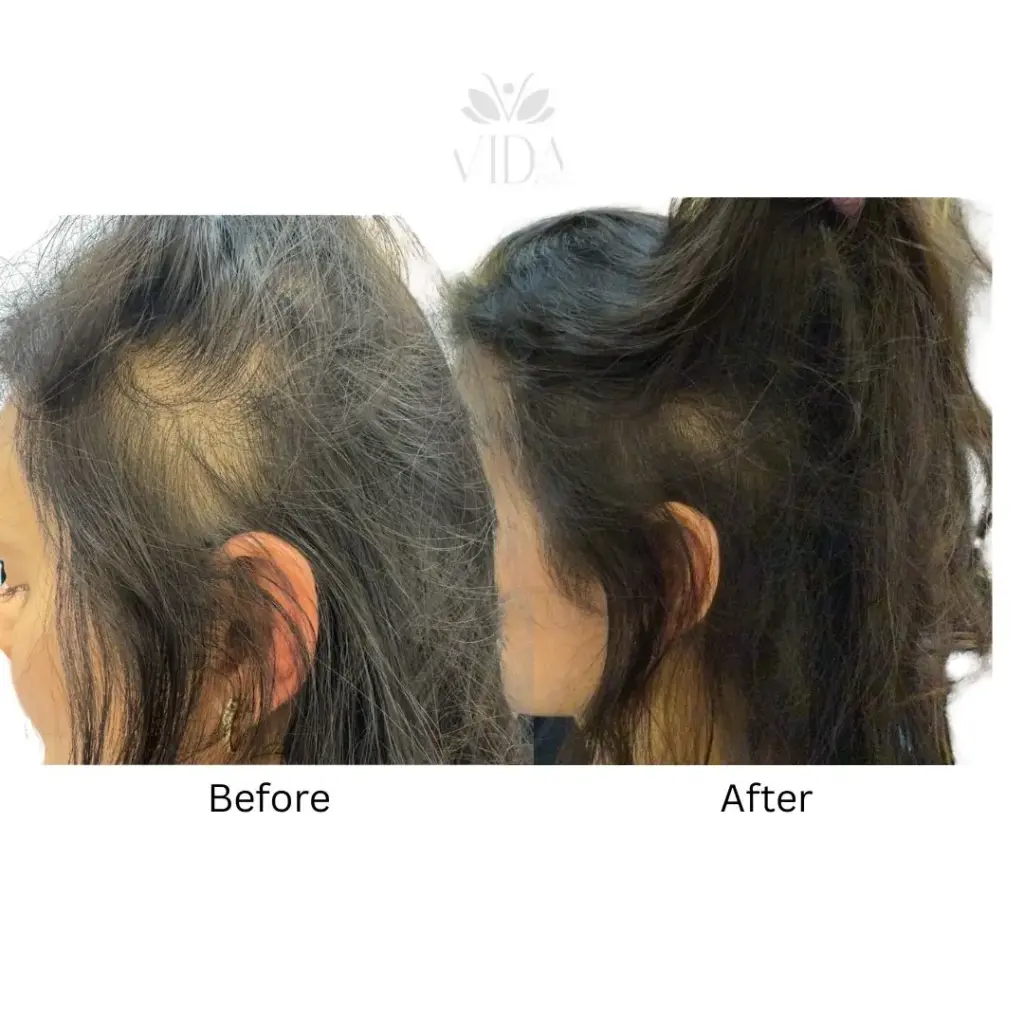 Hair Restoration