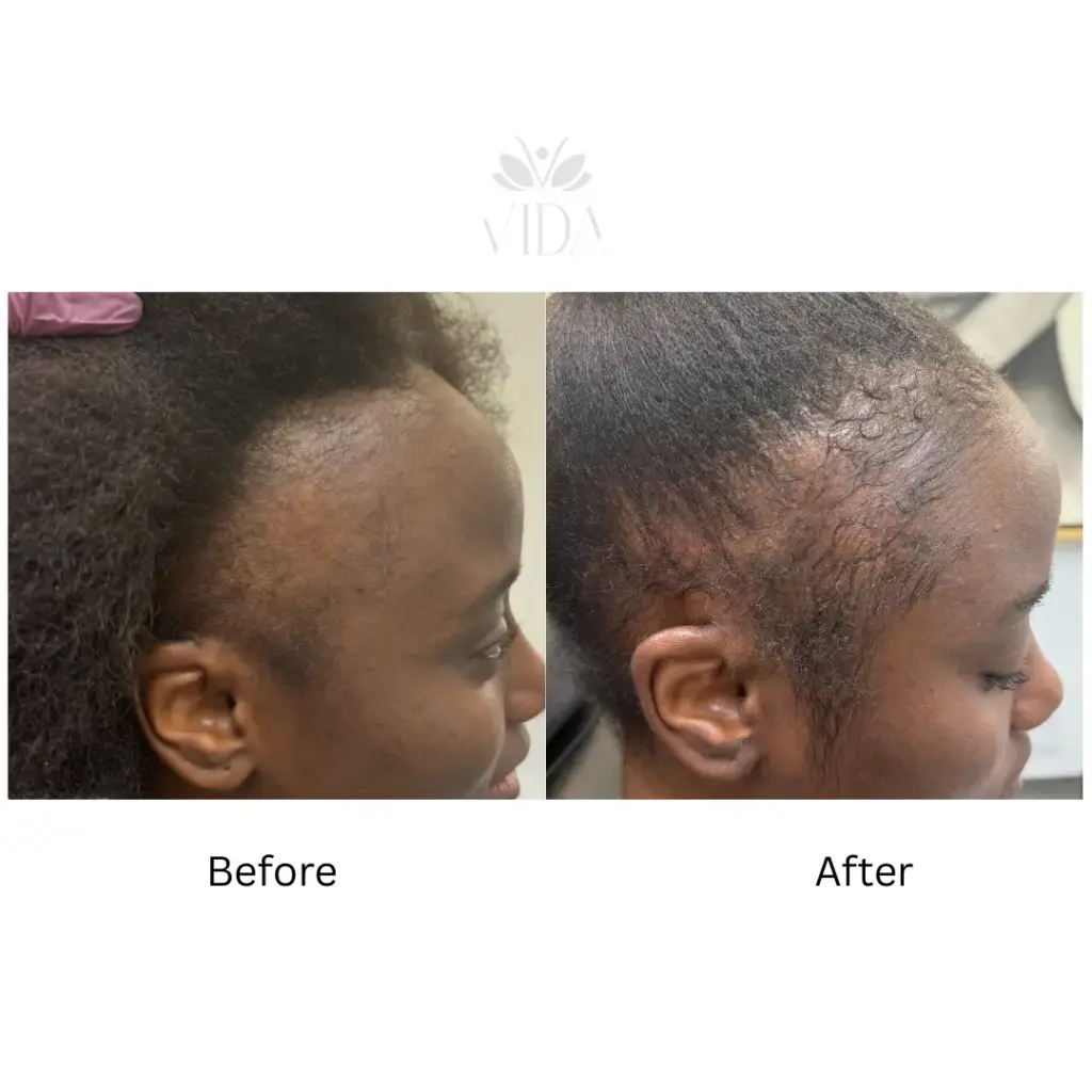 Hair Restoration 2