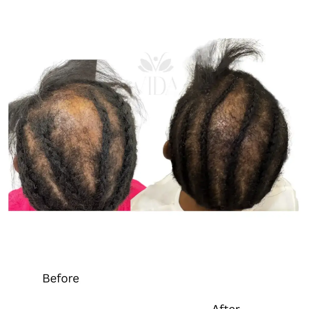 Hair Restoration 3