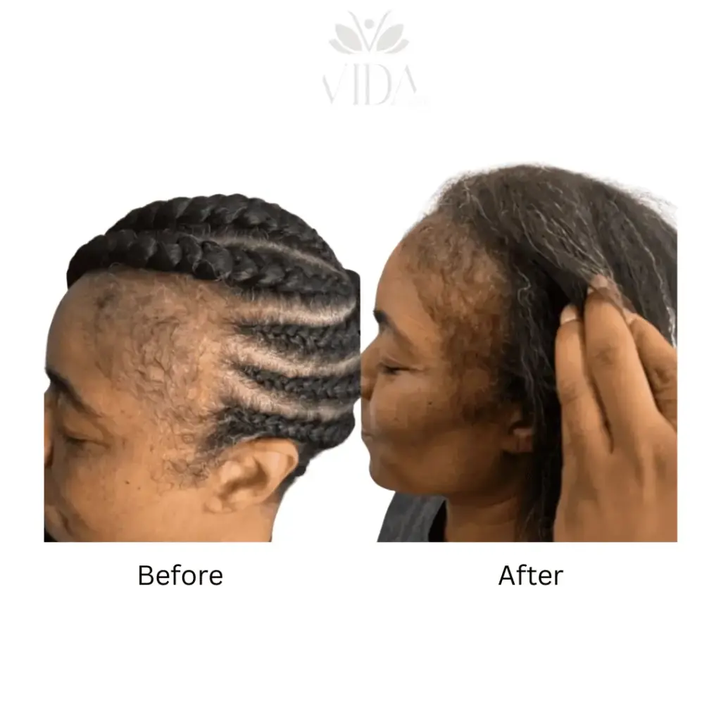 Hair Restoration-Before-after (1)