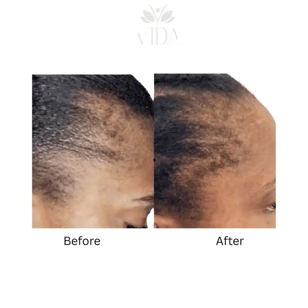Hair Restoration-Before-after (10)