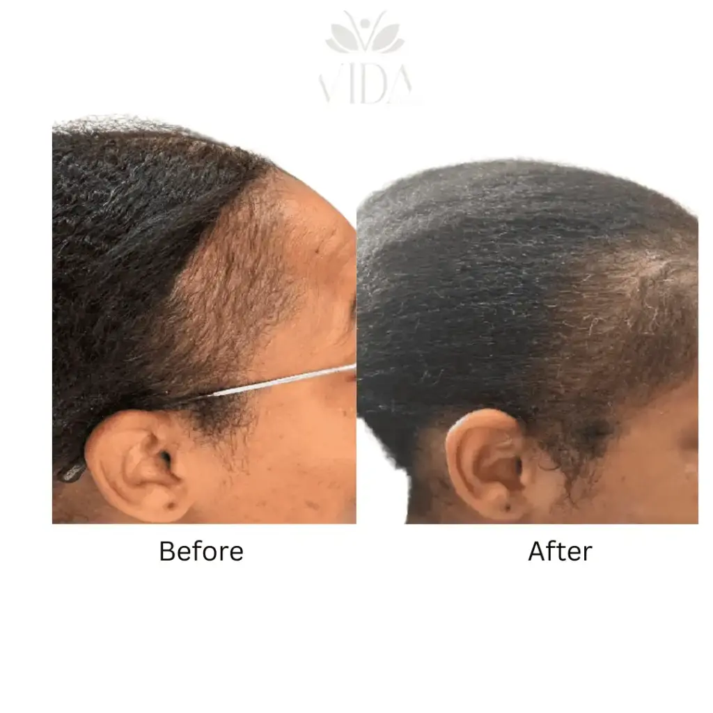 Hair Restoration-Before-after (11)