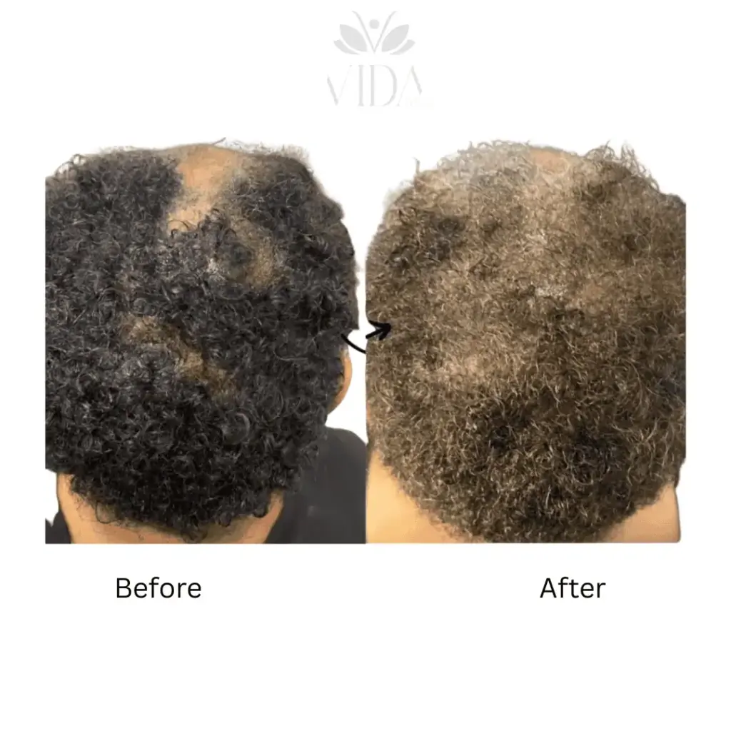Hair Restoration-Before-after (12)