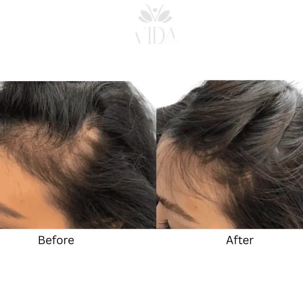 Hair Restoration-Before-after (2)