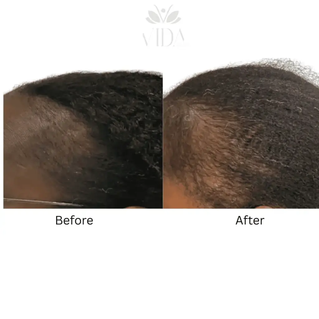 Hair Restoration-Before-after (3)
