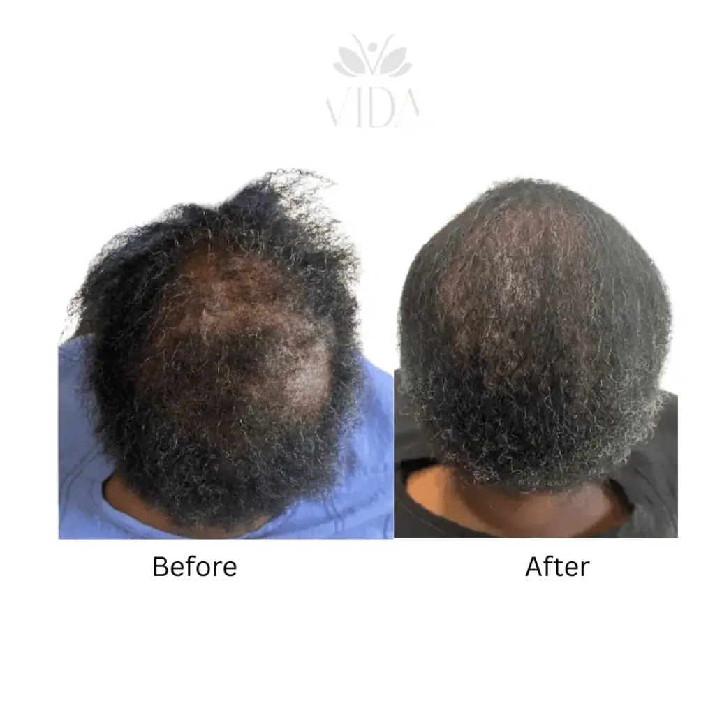 Hair Restoration-Before-after (4)