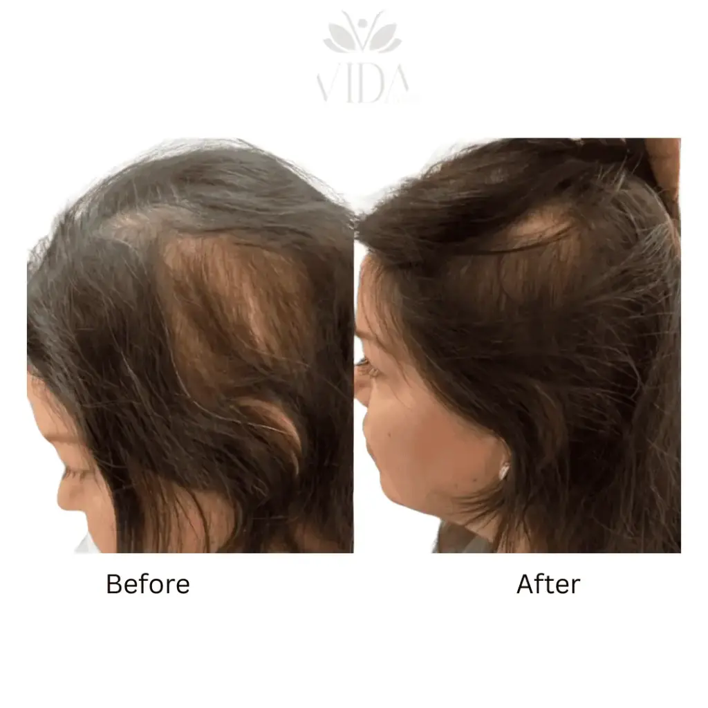 Hair Restoration-Before-after (5)