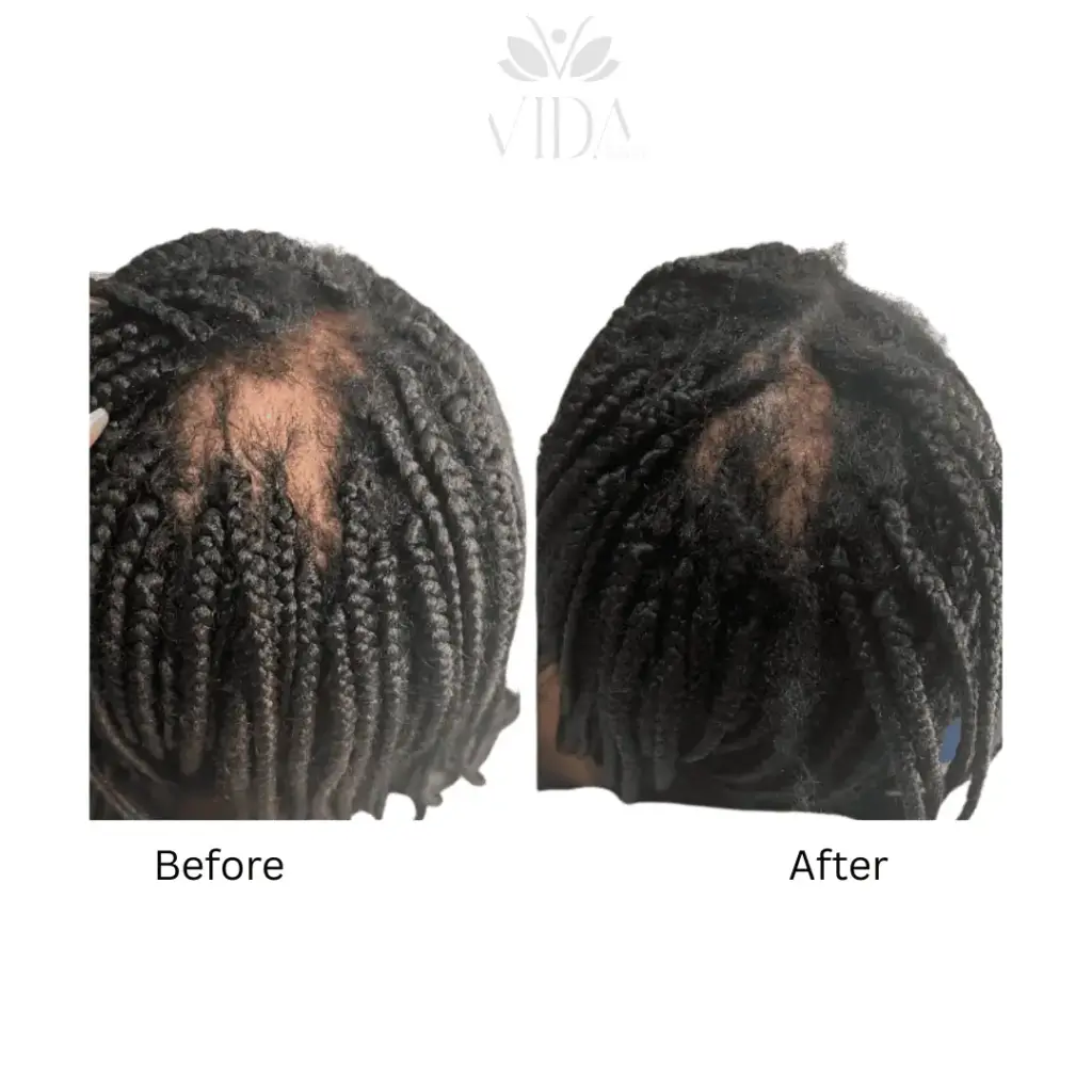 Hair Restoration-Before-after (6)