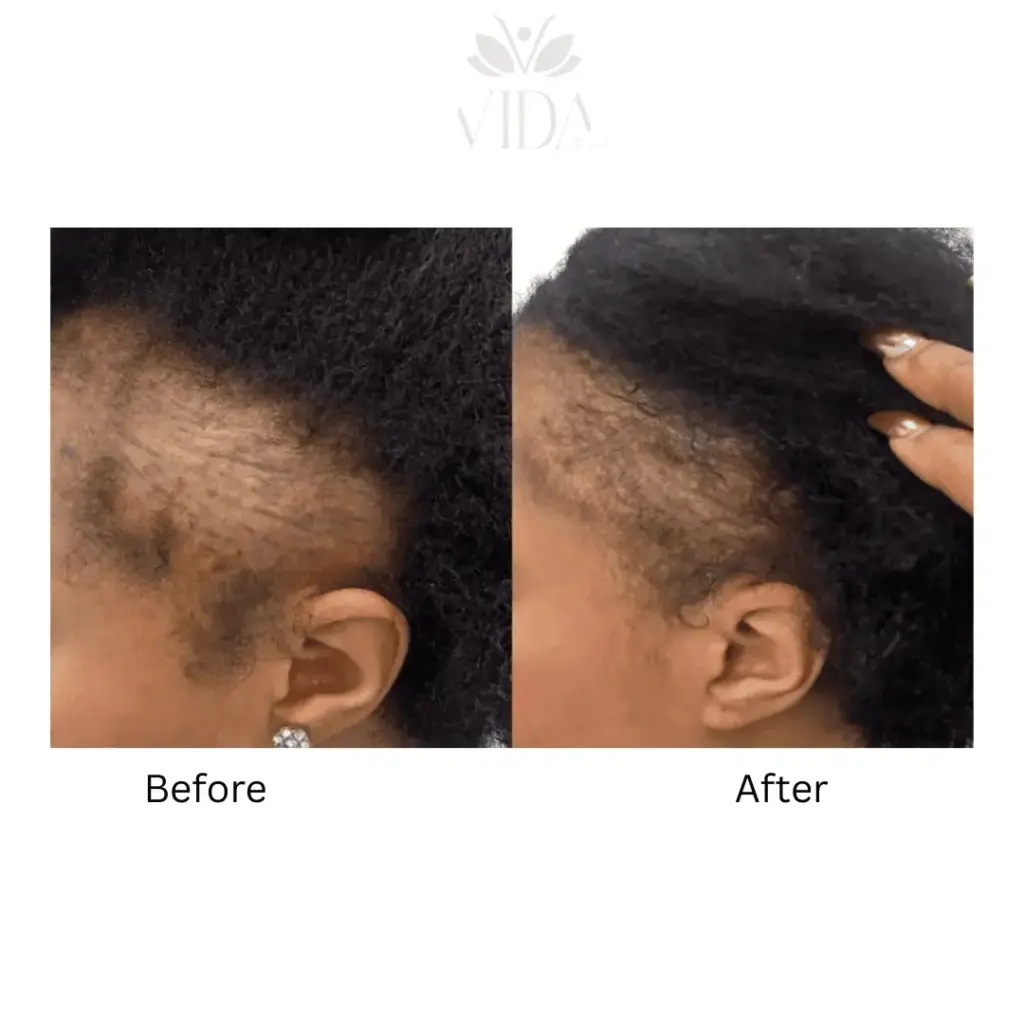 Hair Restoration-Before-after (7)