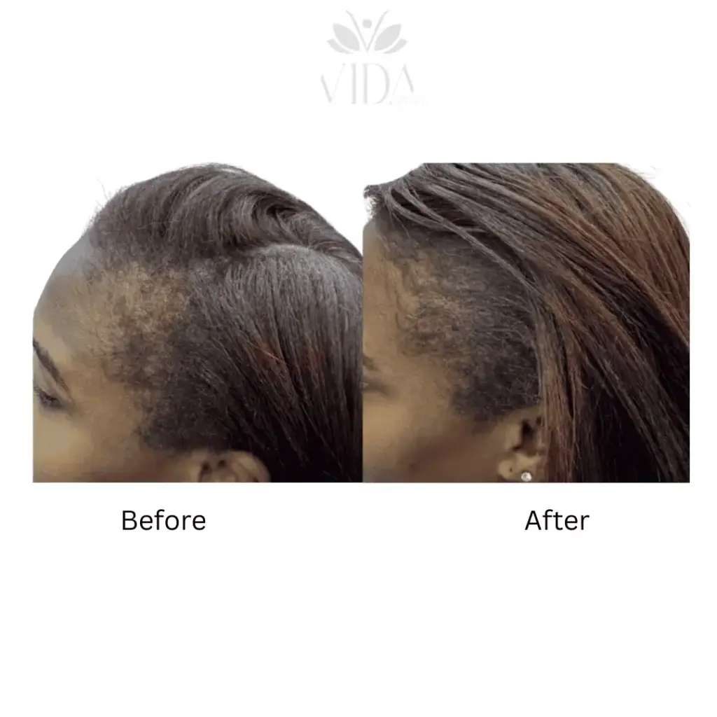 Hair Restoration-Before-after (8)