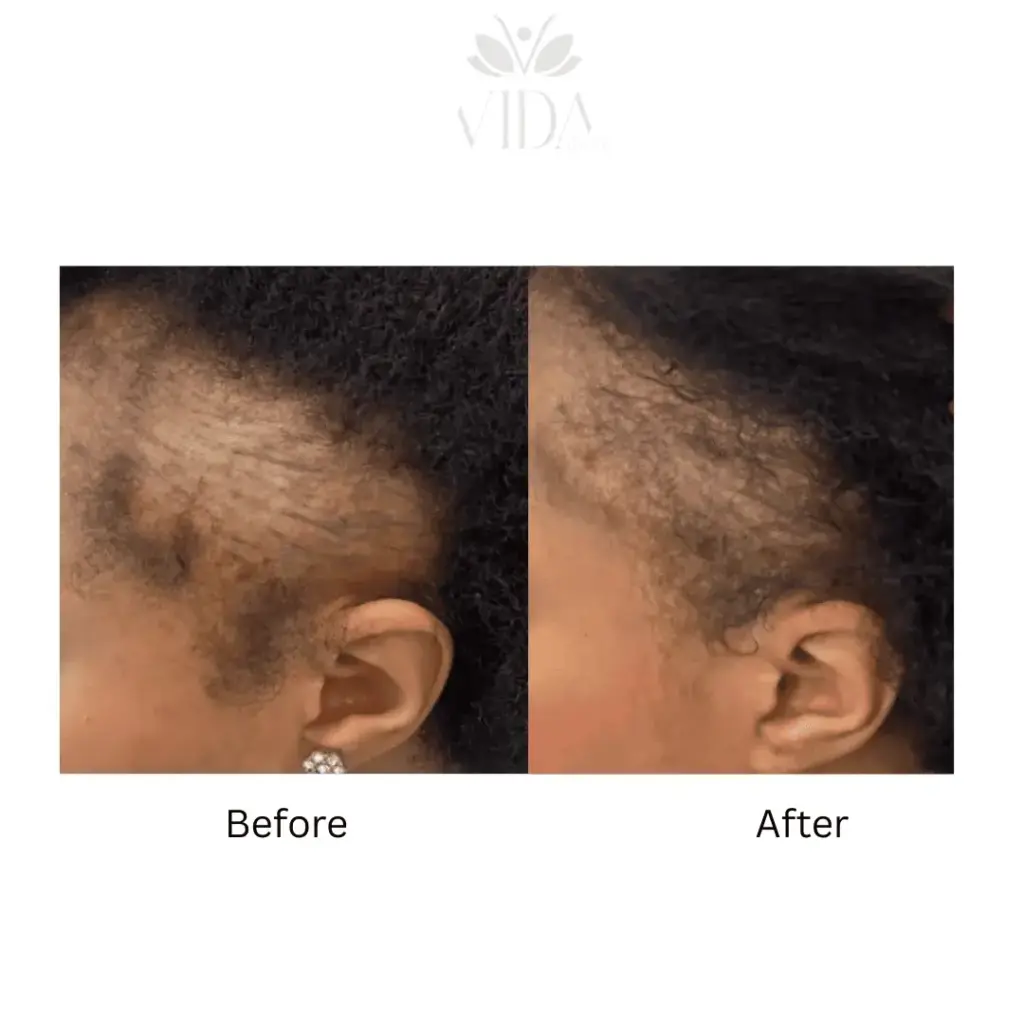 Hair Restoration-Before-after (9)