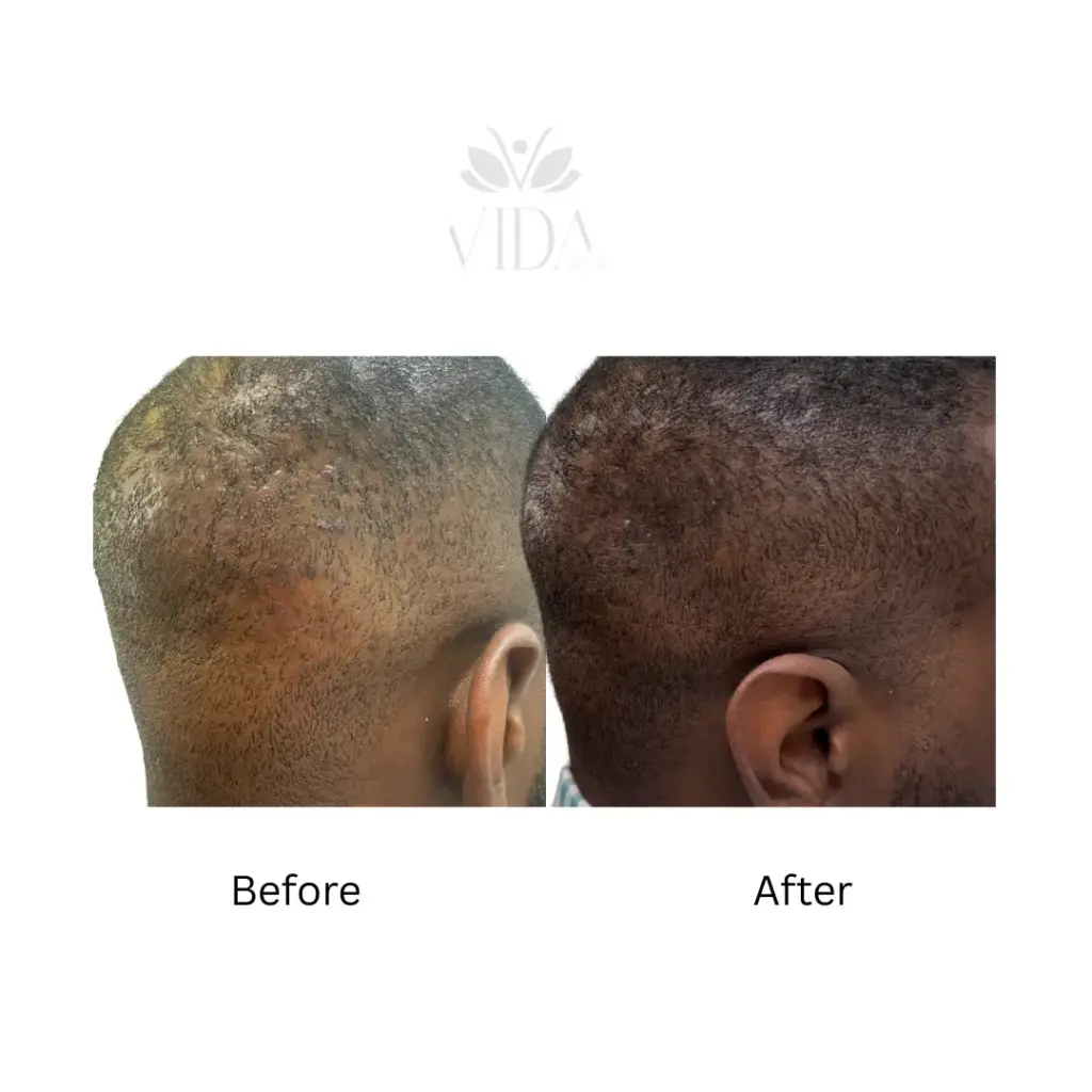 hair restoration