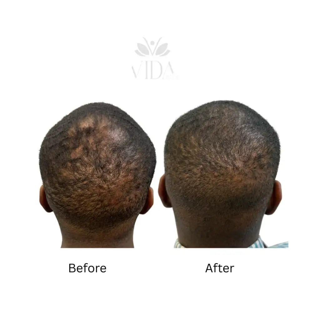hair restoration 3 (1)