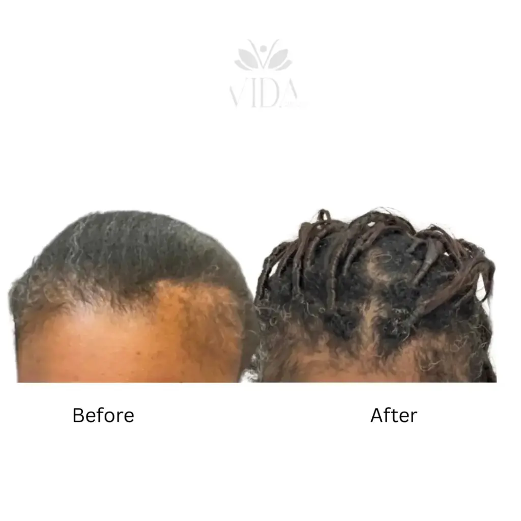 hair restoration 4