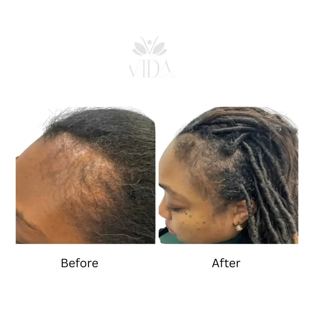 hair restoration 5