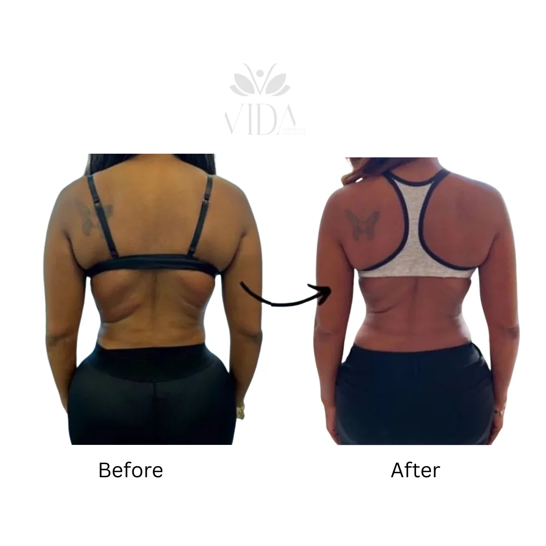 Lipodissolve-allmyvida1