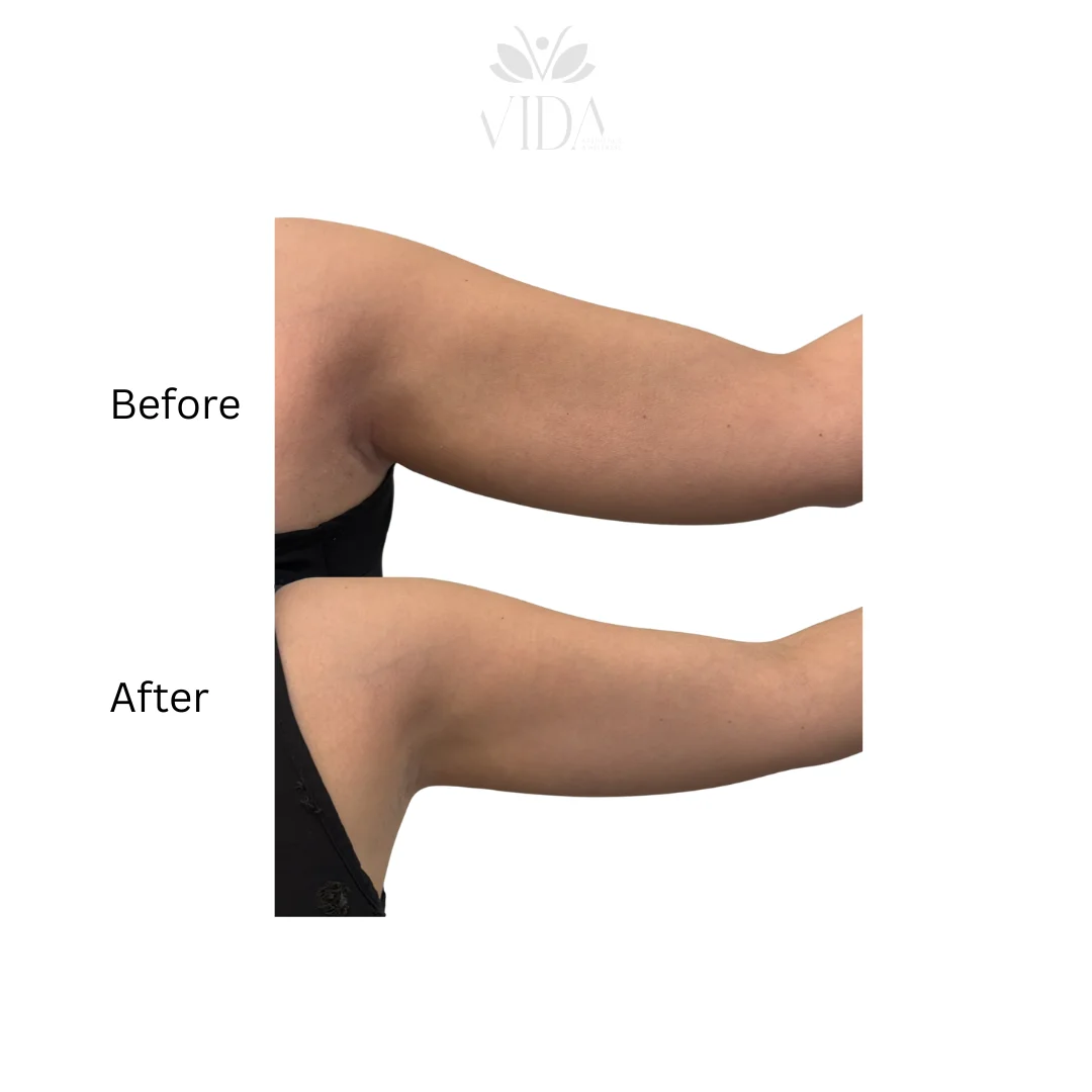 Lipodissolve-allmyvida2