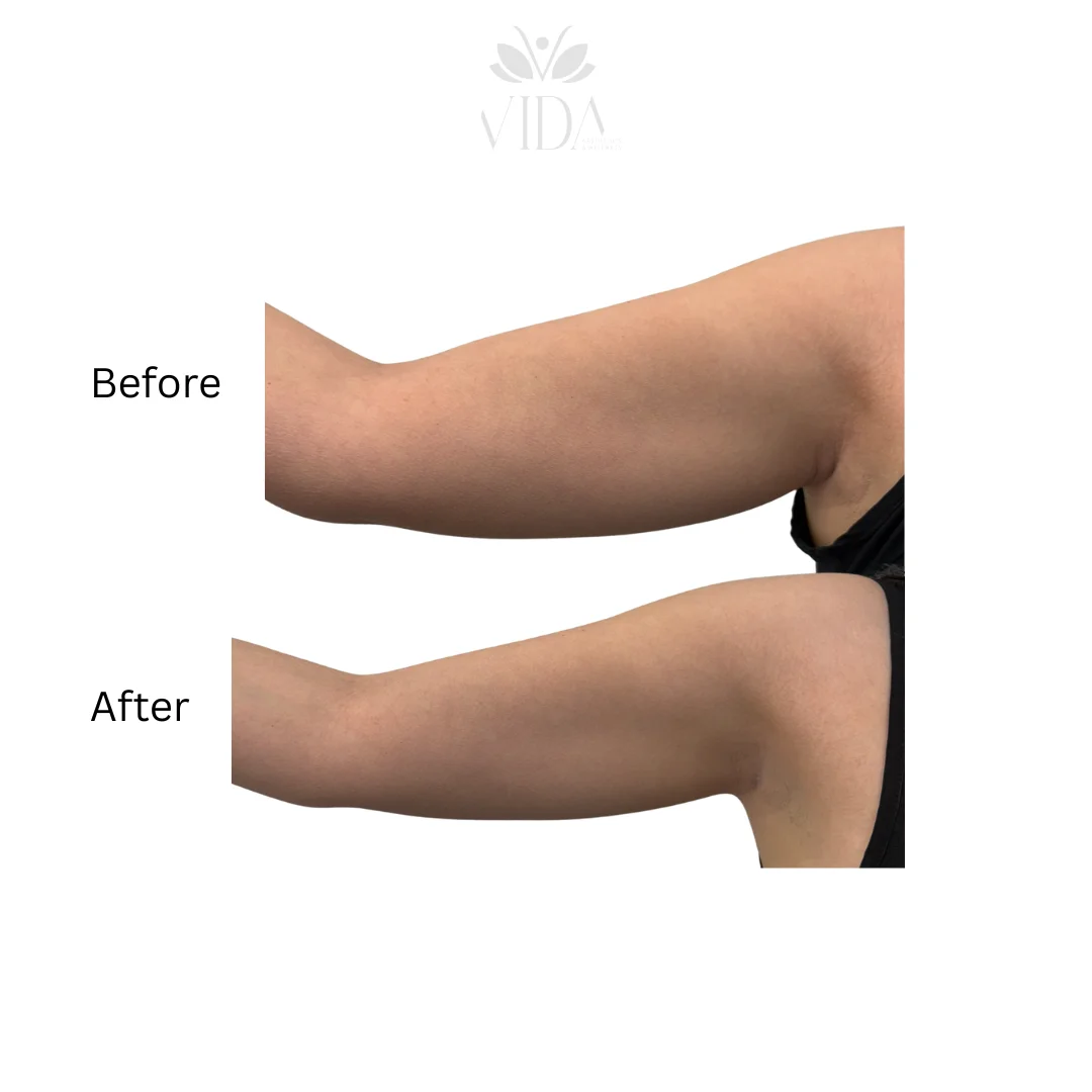 Lipodissolve-allmyvida3