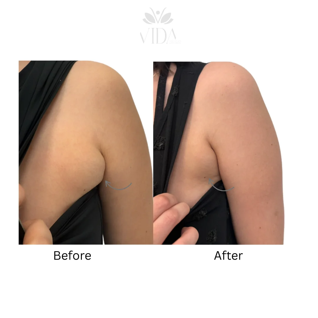 Lipodissolve-allmyvida4