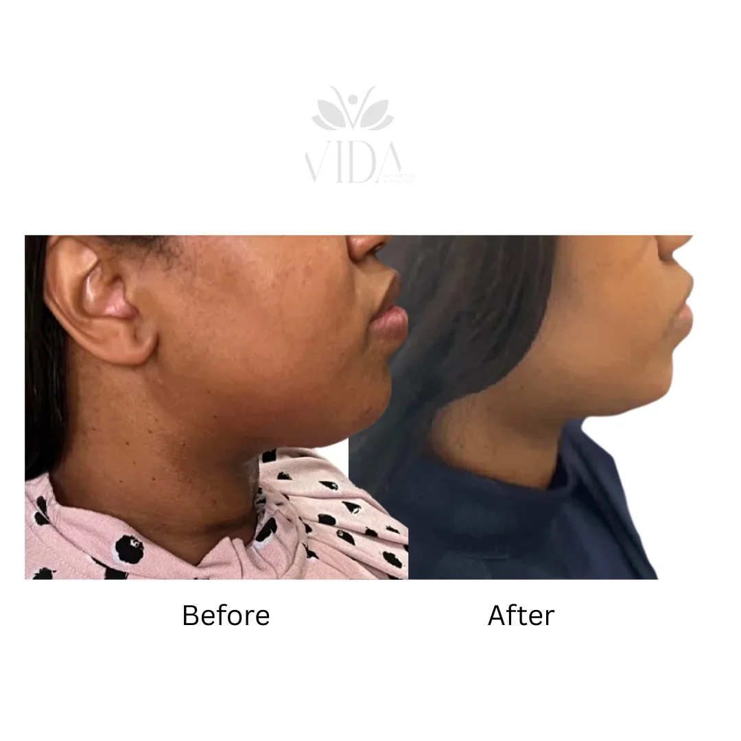 Lipodissolve-allmyvida5