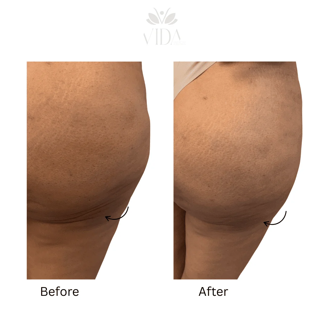 Liquid BBL Treatment Patient Before and After Photos in Houston, TX