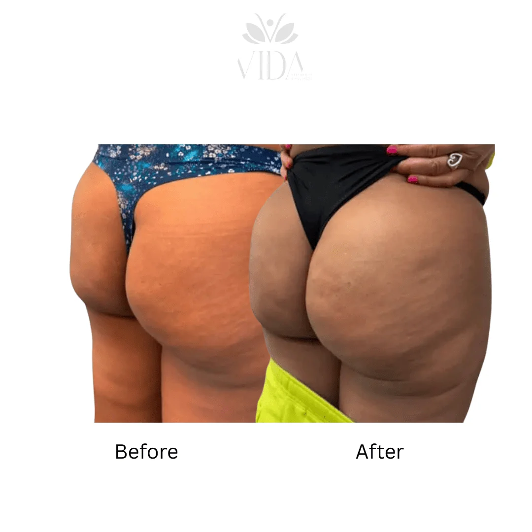 Liquid BBL Treatment Patient Before and After Photos in Houston, TX