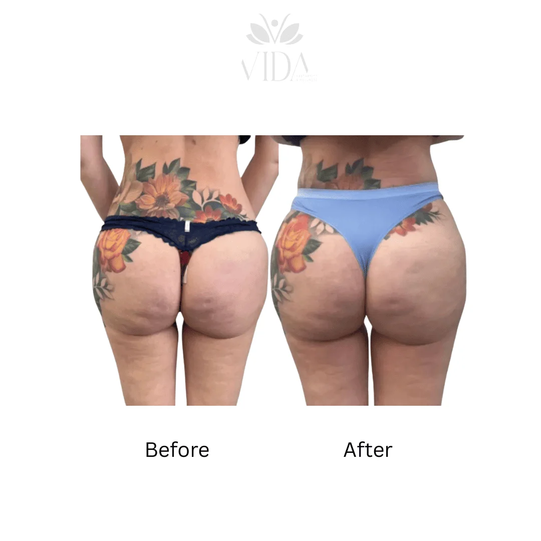 Liquid BBL Treatment Patient Before and After Photos in Houston, TX