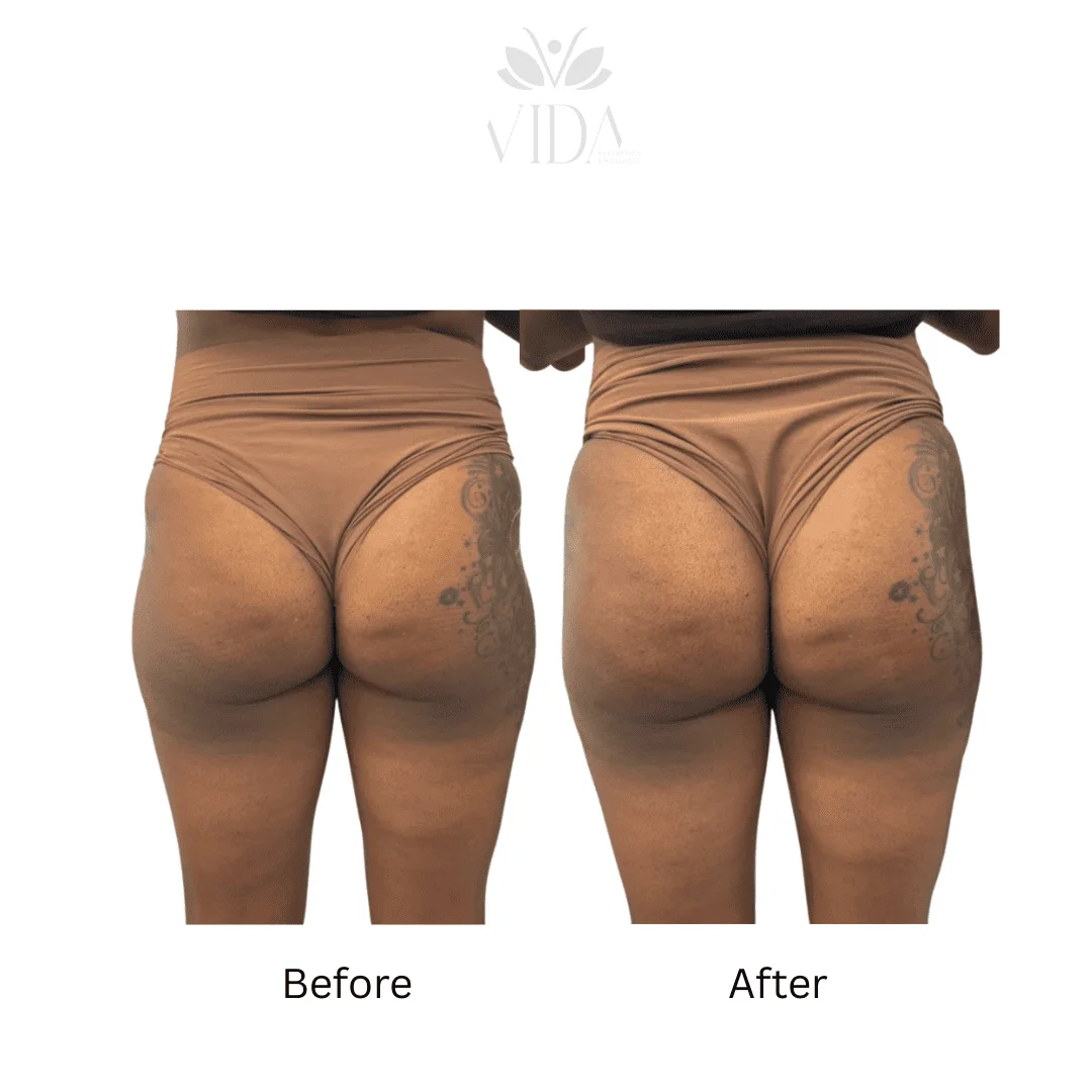 Liquid BBL Treatment Patient Before and After Photos in Houston, TX