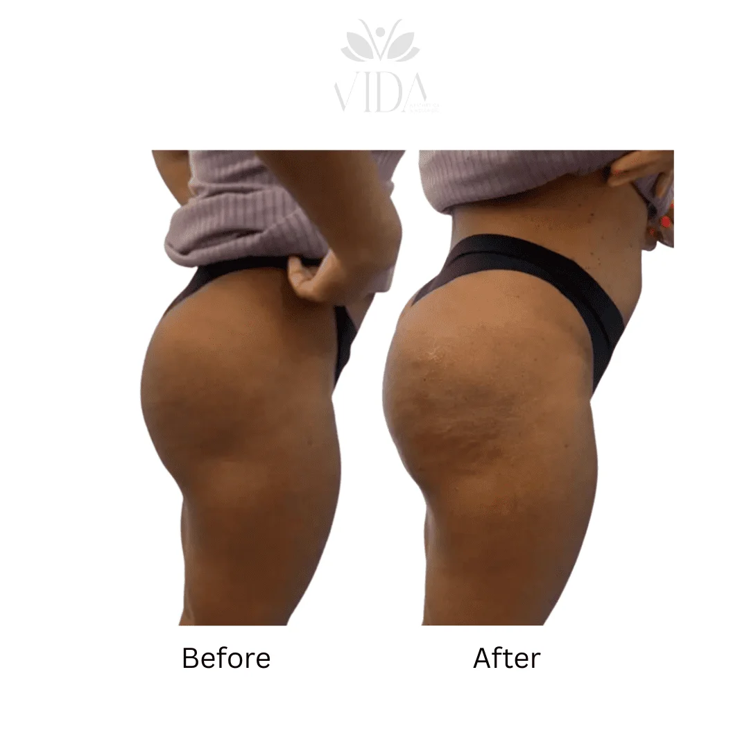 Liquid BBL Treatment Patient Before and After Photos in Houston, TX