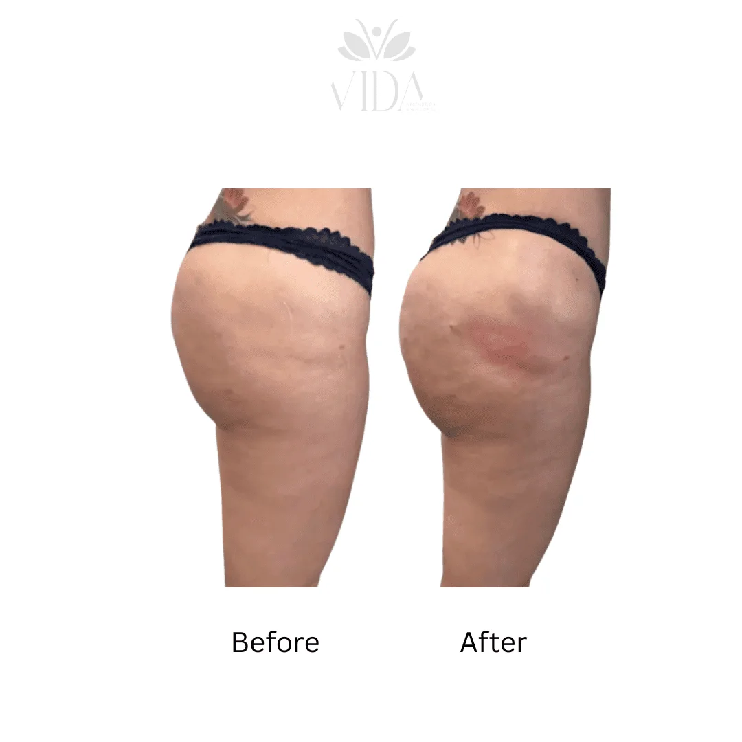 Liquid BBL Treatment Patient Before and After Photos in Houston, TX