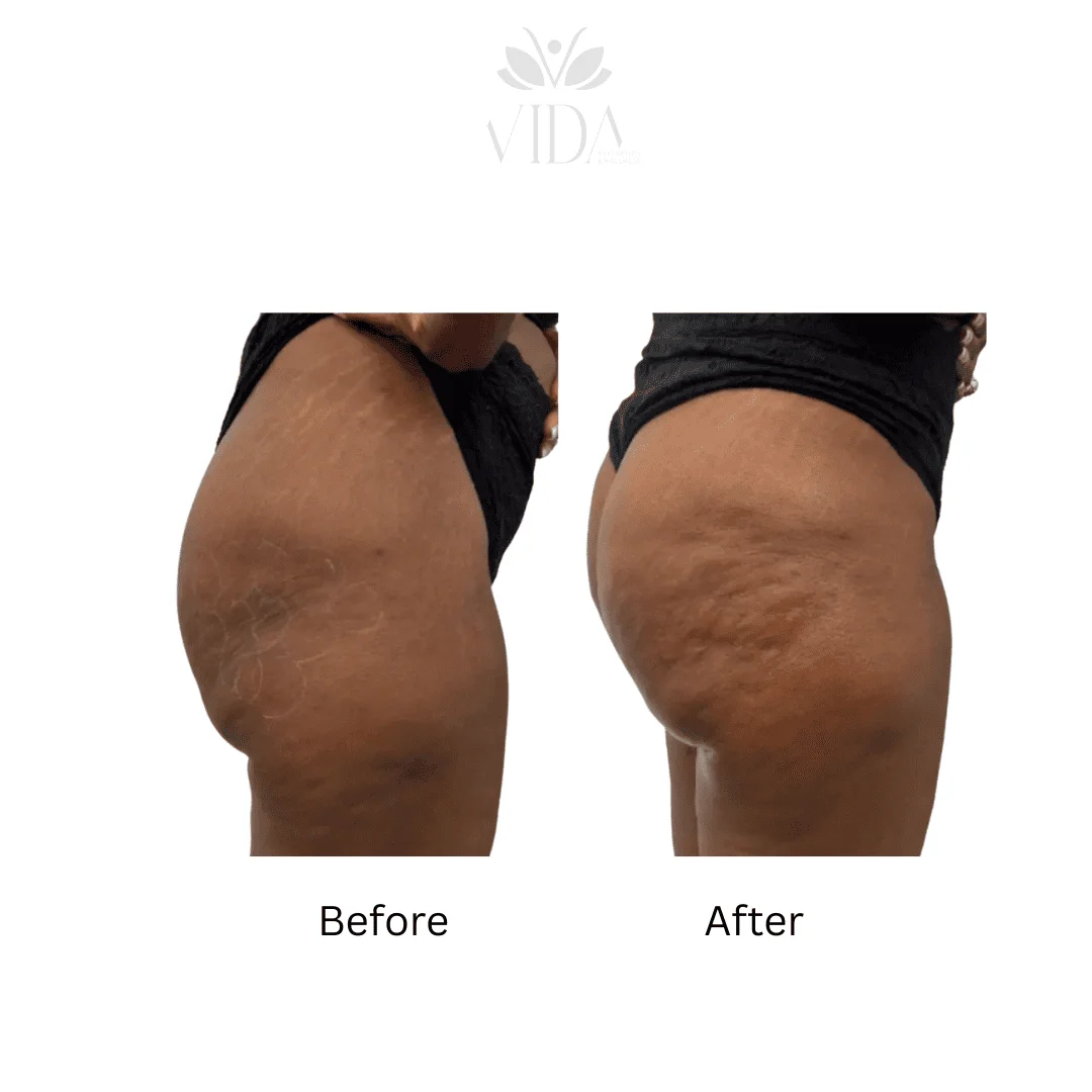 Liquid BBL Treatment Patient Before and After Photos in Houston, TX