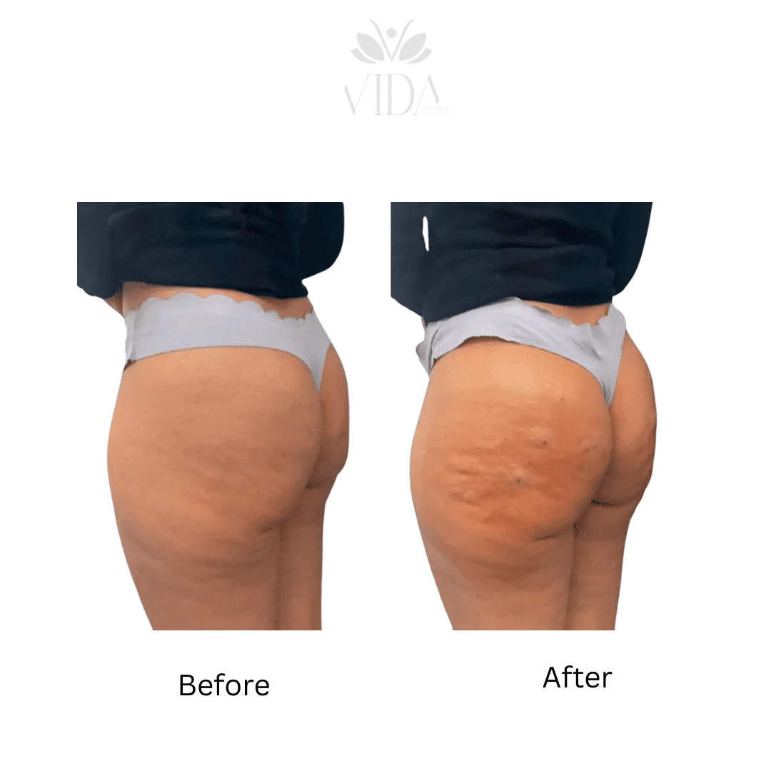 Liquid BBL Treatment Patient Before and After Photos in Houston, TX | Vida Aesthetics And Wellness