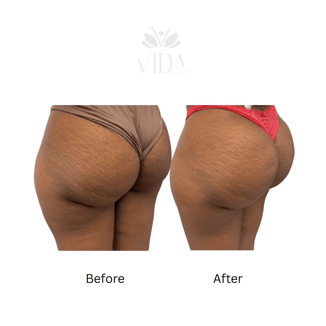 Liquid BBL Treatment Patient Before and After Photos in Houston, TX | Vida Aesthetics And Wellness