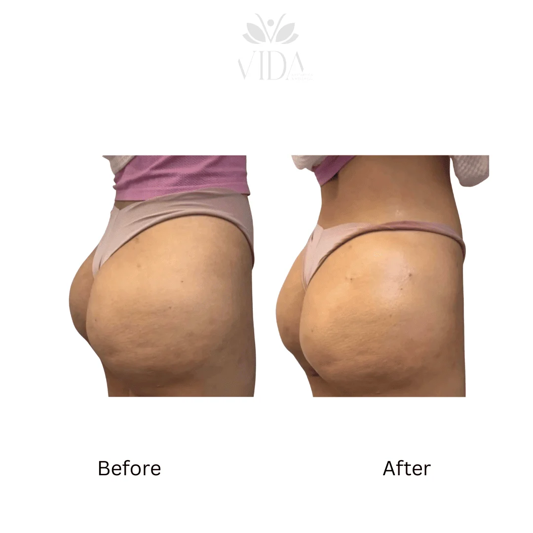 Liquid BBL Treatment Patient Before and After Photos in Houston, TX | Vida Aesthetics And Wellness